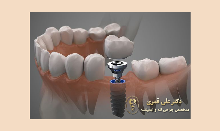 کاربرد ایمپلنت دندان در ترمیم تک دندان