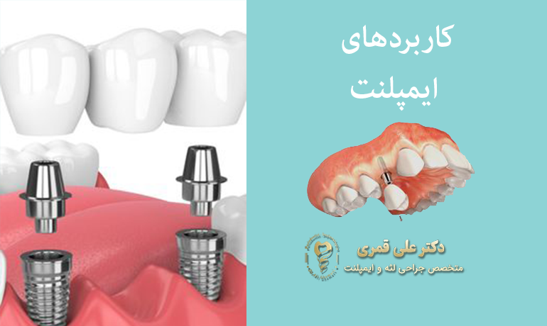 کاربردهای ایمپلنت دندان