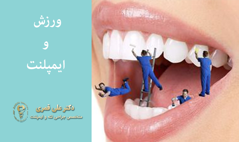 ورزش بعد ایمپلنت