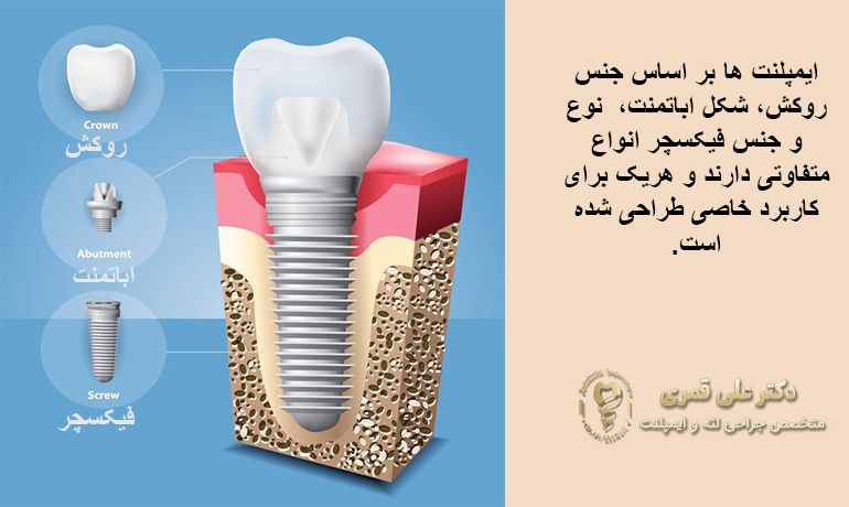 انواع ایمپلنت برای کاربردهای گوناکون