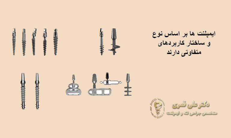 انواع ایمپلنت بر اساس فیکسچر