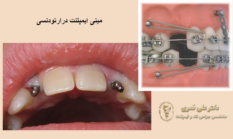 انواع ایمپلنت بر اساس محل کاشت