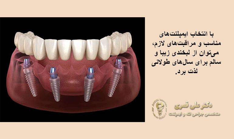انواع ایمپلنت