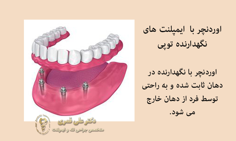 اوردنچر با نگهدارنده توپی