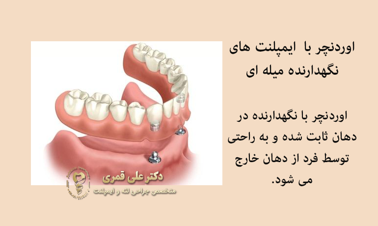 اوردنچر با نگهدارنده میله ای