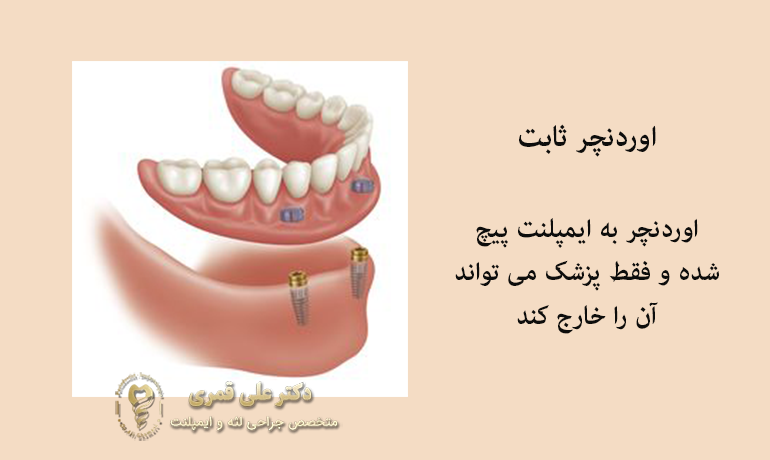 اوردنچر ثابت