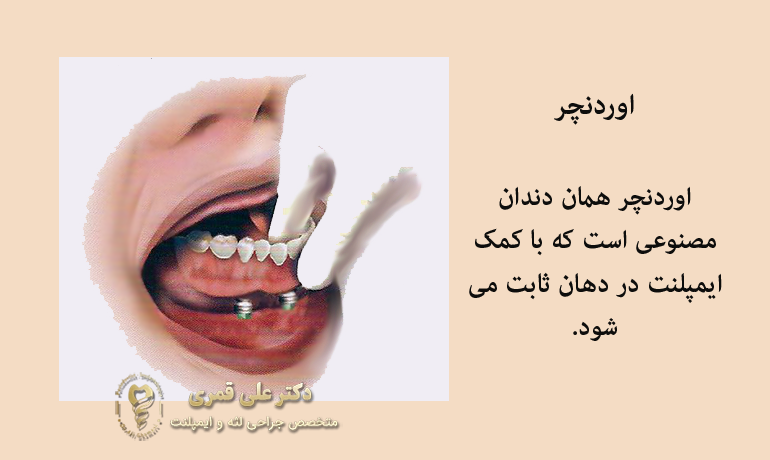 اوردنچر