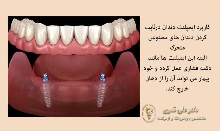 کاربرد ایمپلنت دندان در ثابت کردن دندان مصنوعی
