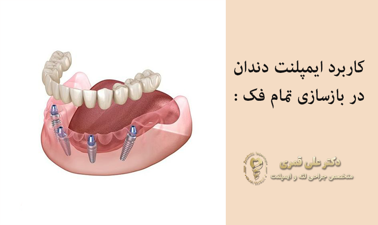 کاربرد ایمپلنت دندان در بازسازی تمام فک