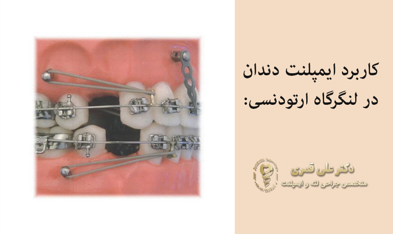 کاربرد ایمپلنت دندان در ارتودنسی