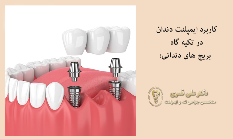 کاربرد ایمپلنت دندان برای بریج