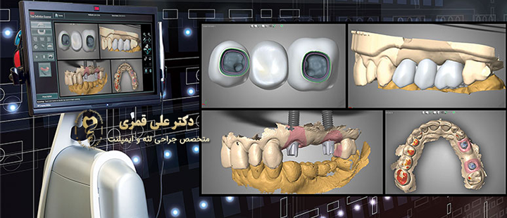 درباره ایمپلنت دیجیتال 