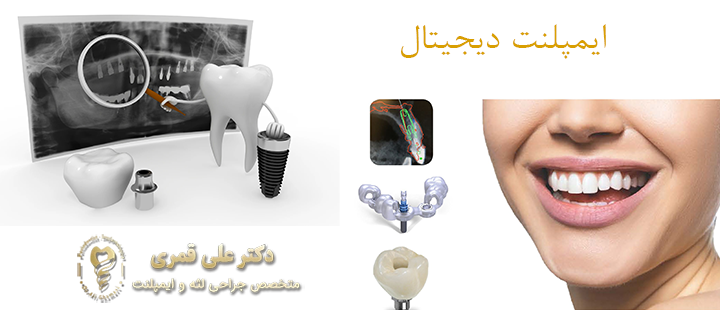 ایمپلنت دیجیتال چیست؟