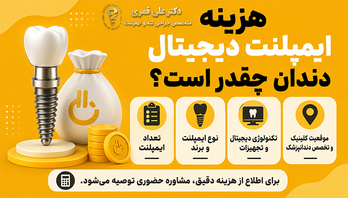 هزینه ایمپلنت دیجیتال دندان چقدر است؟