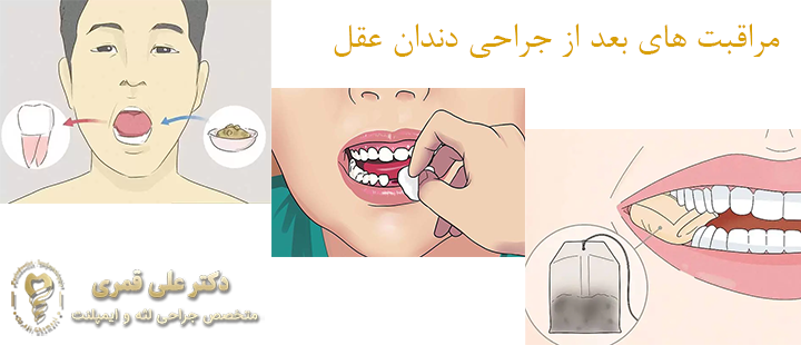 آشنایی با مراقبت های بعد از جراحی دندان عقل