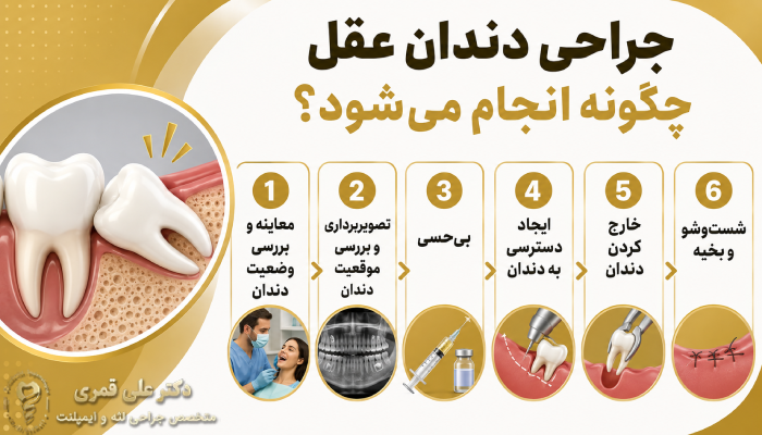 جراحی دندان عقل چگونه انجام میشود؟