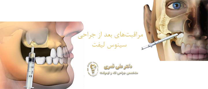 درباره مراقبت‌های بعد از جراحی سینوس لیفت 