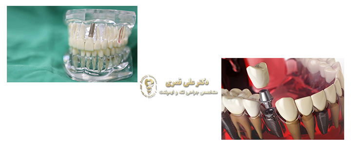 ارتباط ایمپلنت دندان و سرطان 