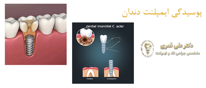درباره پوسیدگی ایمپلنت دندان 