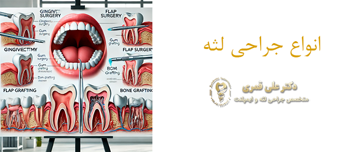 درباره انواع جراحی لثه 