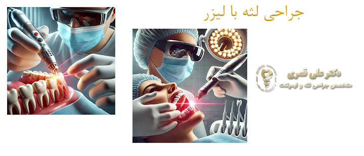 درباره جراحی لثه با لیزر 