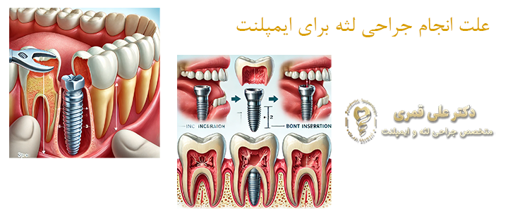 درباره انجام جراحی لثه برای ایمپلنت 