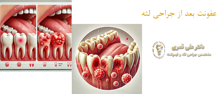 درباره عفونت بعد از جراحی لثه 