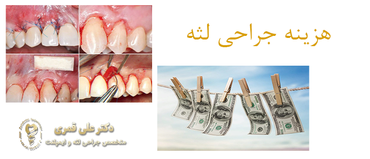 هزینه جراحی لثه چقدر است؟