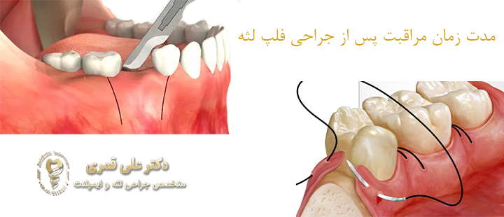 مدت زمان مراقبت پس از جراحی فلپ لثه