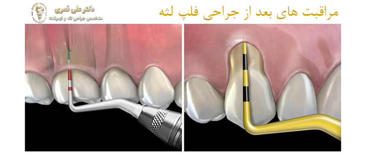 مراقبت های بعد از جراحی فلپ لثه