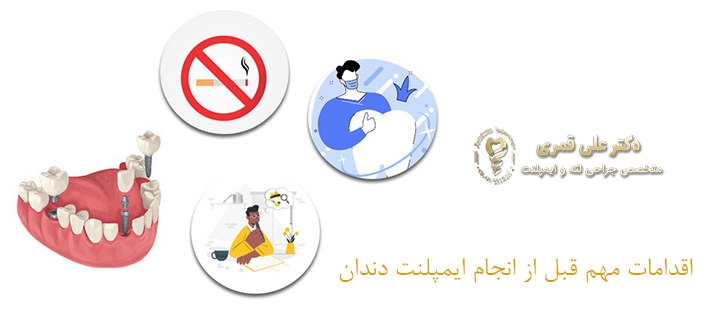 اقدامات مهم قبل از انجام ایمپلنت دندان